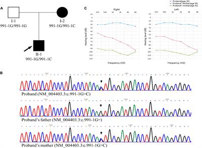 Case Report: Novel Heterozygous DFNA5 Splicing Variant Responsible for Autosomal Dominant Non-syndromic Hearing Loss in a Chinese Family